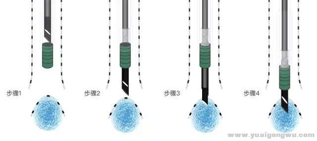 穿刺活检会导致癌细胞转移2.jpg